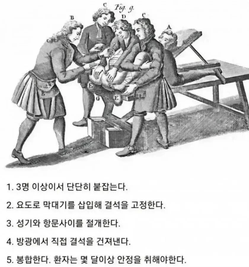의술이 발전하기 전 요로결석 치료법