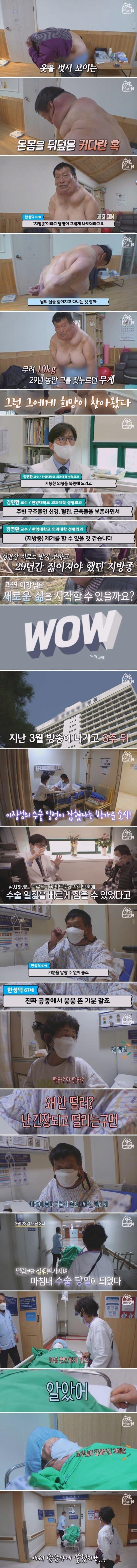 29년 만에 7kg 지방종을 없앤 남자 ㄷㄷㄷ