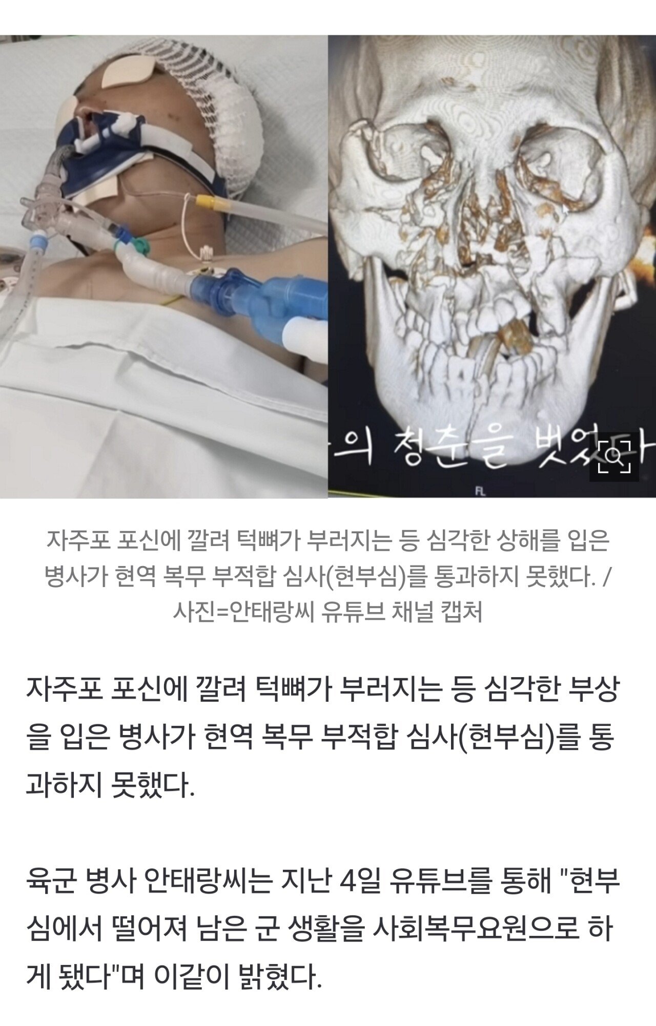 얼굴뼈 으스러져 대수술…여단장 "부대 복귀해 통원 치료 받자"