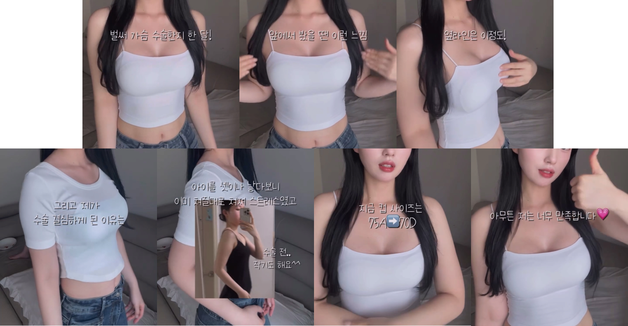 ㅇㅎ) 예전보다 많이 대중화 된 거 같은 성형수술 분야