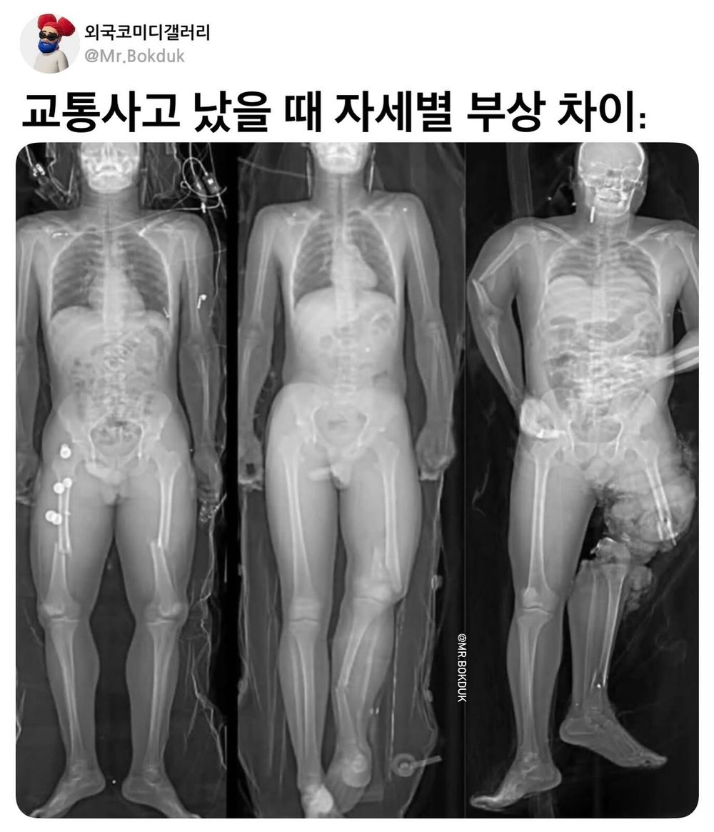 교통사고 자세별 부상 차이